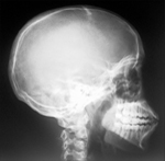 Head X-ray