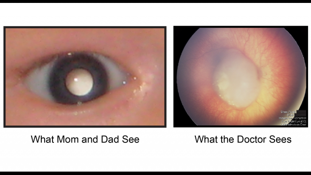 Full-Size Image: Eye Tumor